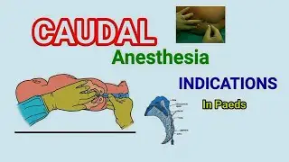 Caudal block and it's indications in Paeds #caudalblack #medical #anaestbesia