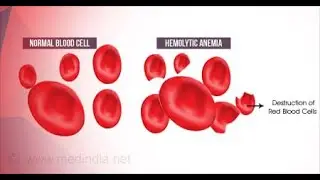 Hemolytic anemia in children; red blood cells are destroyed faster than Production