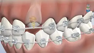 Expose and Bond in Springfield IL at Oral & Facial Surgeons of Illinois