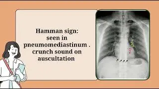 Hamman vs hooman sign #hammansign #hoomansign #medicine
