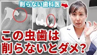 どの程度の虫歯なら削らなくても治せるの？