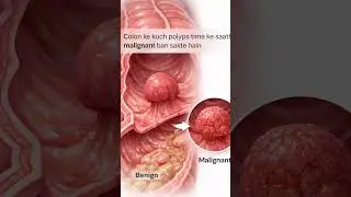 Tumor vs Cancer Explained in Hindi | Medical Awareness Short #healthylifestyle #medicalawarenes