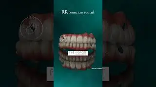 Fire & Forget by RR Dental Labs | Instant Implant Prosthesis for Full-Arch Restoration