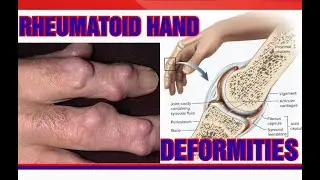 Rheumatoid hand deformities|Boutonniere deformity, Swan neck, Mallet finger, R- nodules & -Z-thumb|