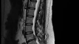 Podcast # 360: Epidural Abscess Screening