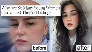 if you're worried you're going bald, this video is for you.