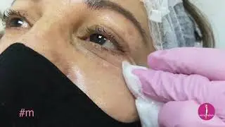 Tratamiento con Mesoterapia Sunekos 200 en Contorno de Ojos, 🤩 +colágeno +hidratación