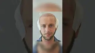 Amazing Hair Transplant Result in Aisha Hair #shorts #short  #beforeandafter #hair #amazing