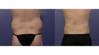 Liposuction at Stoker Plastic Surgery | Los Angeles