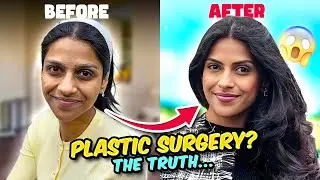 My Plastic Surgery Story | Swarda Thigale