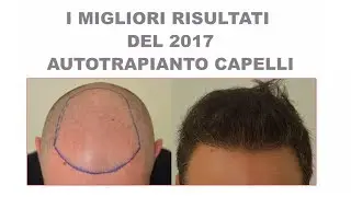 Trapianto Capelli F.U.E. - I migliori risultati del 2017