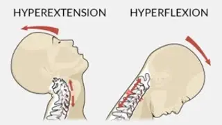 Types of Spinal Cord Syndromes(BCD) 