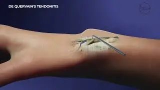 Dr Samuel Poulain De Quervain's Tendonitis Surgery  CliPlateau VA