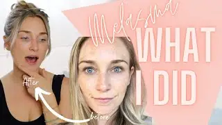 MELASMA | How I improved my MELASMA | What I changed to help my skin heal