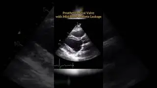 Prosthetic Mitral Valve #echocardiogram #echo   Echocardiography For Beginners