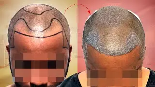Receding Hairline Restoration 👦 My Experience with New Roots | Hyderabad | Telugu
