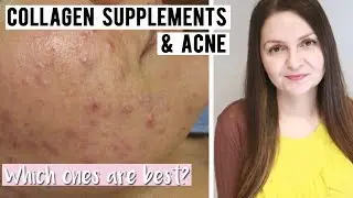 Best Collagen Supplements for Acne Prone Skin - Supplements for Clear Skin