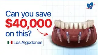 Cost of Dental Implants in Los Algodones, Mexico: How Do They Promise No-Hidden Costs?