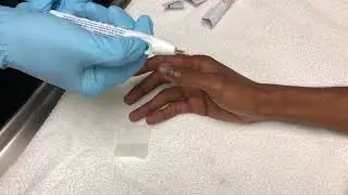 Subungual Hematoma and Trephination