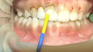 RadioFrequency Cautery Machine For Dental Use Full Product Video With Price |DrSparsh Nigam 2025