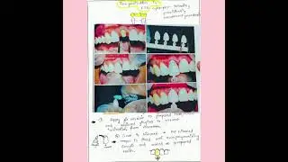 Temporization in FPD/ Provisional restoration ||LAQ|| NOTES