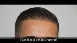 FUE - Dense Pack Hair transplant with 2500 FUE Hair Grafts
