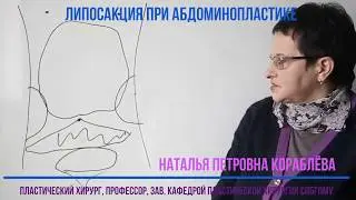 Липосакция при абдоминопластике