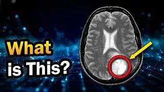 What Does a Brain MRI Show? (Tumors, Stroke, & MS Explained)