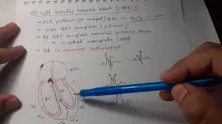 Clinical ECG Interpretation in Bangla (Part-3): RBBB, LBBB, Bifascicular & Trifascicular block