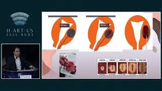 Angel Santalla - RF technology in the myoma treatment
