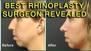 Rhinoplasty Lehigh Valley  610 770 7676 Affordable Plastic Surgery in PA