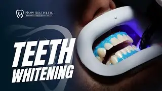 Teeth Whitening! I Now Aesthetic