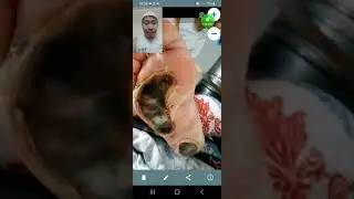 СуперНова кремнен нәтежие.Сахарный диабет
