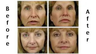 Sonata Laser Fillers // Production by Lemonlight Media
