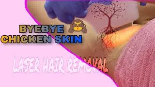 Underarm Hair Removal | Whitening Laser Treatment at Skin911 | Wander Nekai Ph