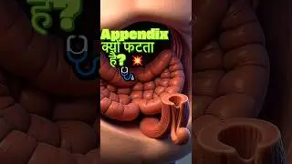 पेट में Appendix क्यों फटता है? 💥🩺#Shorts #Appendix #MedicalFacts #Surgery #HumanBody #HindiShorts