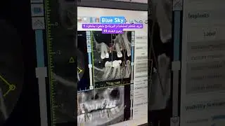 Implant planning using Blue Sky Plan software #implantplanning ء#digitaldentistry