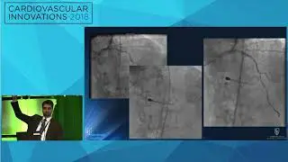 CVI2018 Session: Innovation in managing severe calcification - Perwaiz Meraj, MD