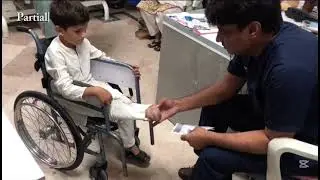 Partial Foot Amputee | From wheelchair to walking on his own foot | Complete Procedure 