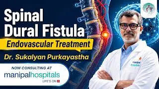 Spinal Dural Fistula