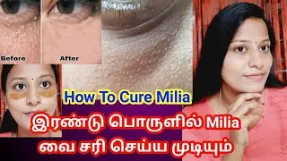 How to remove milia permanently using home remedies / How To Get Rid Of Milia/Tiny bumps Naturally