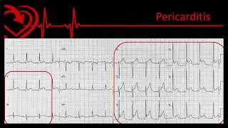 12-Lead Part 7,  STEMI Imposters