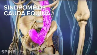 Síndrome de Cauda Equina