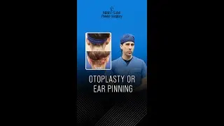 Otoplasty Or EarPinning #Otoplasty #EarPinning