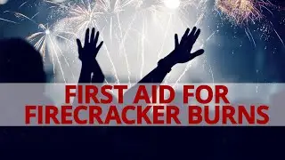How to do First Aid for Firecracker Burns? #BeALifesaver