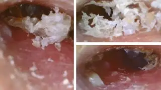 Nia v23 cleaning mold in dirty ear canal  #耳道黴菌清理過程