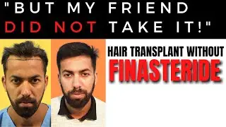 Another hair transplant result without Finasteride | at Darling Buds Clinic