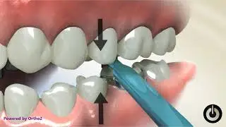 Molar Band Placement