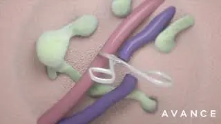 Lymph node Transfer Dr. Erez Dayan Avance Plastic Surgery