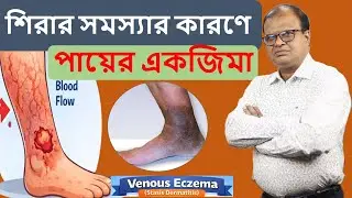 Leg eczema due to venous problems | Venous Eczema | Homeopathic treatment